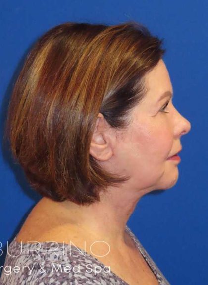 Neck Lift Before & After Patient #1578
