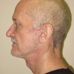 Facelift Before & After Patient #1675