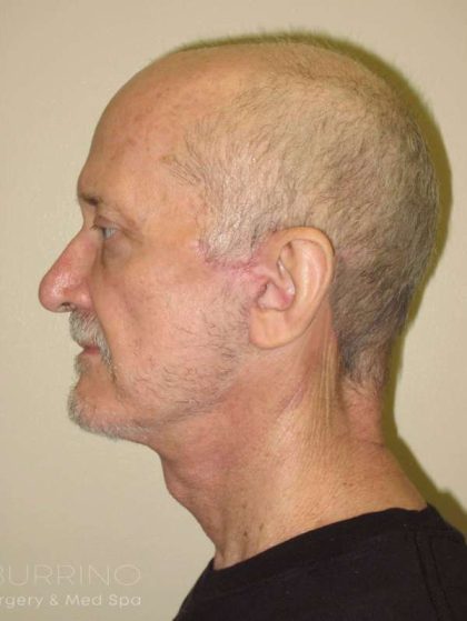 Facelift Before & After Patient #1675