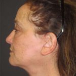 Facelift Before & After Patient #1682