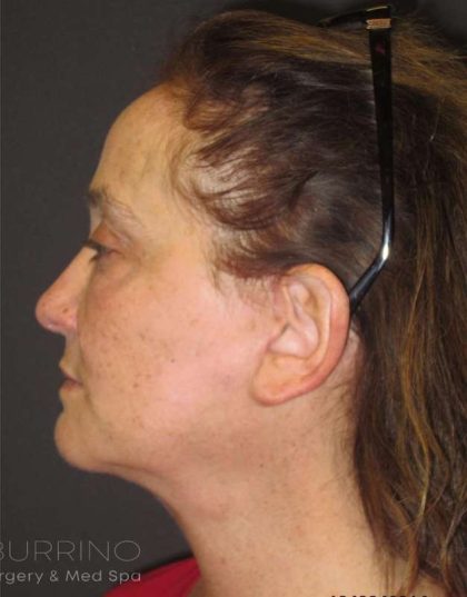 Facelift Before & After Patient #1682