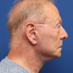 Facelift Before & After Patient #1693
