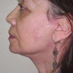 Facelift Before & After Patient #1700