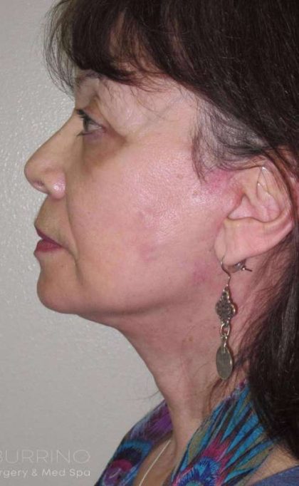 Facelift Before & After Patient #1700