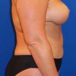 Breast Reduction Before & After Patient #1797
