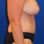 Breast Reduction Before & After Patient #1808