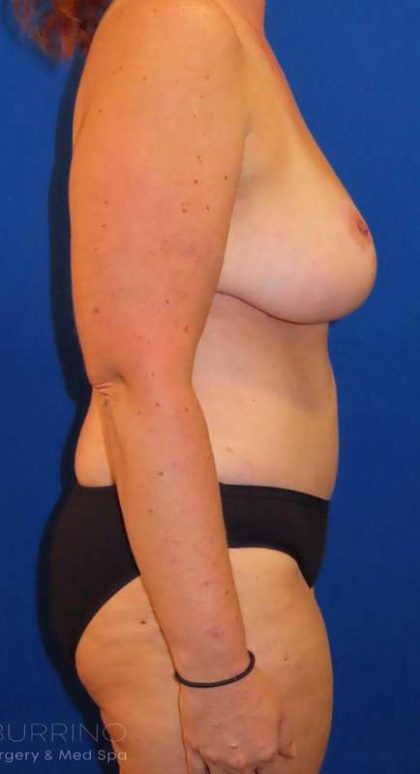 Breast Lift Before & After Patient #1880