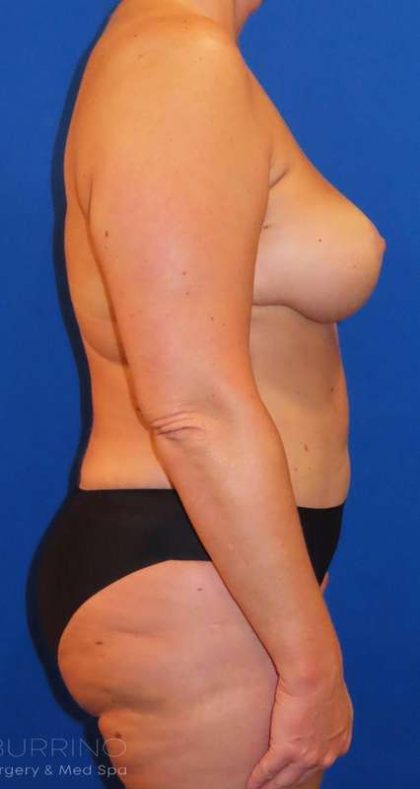 Breast Lift Before & After Patient #1915