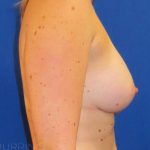 Breast Augmentation Before & After Patient #2000