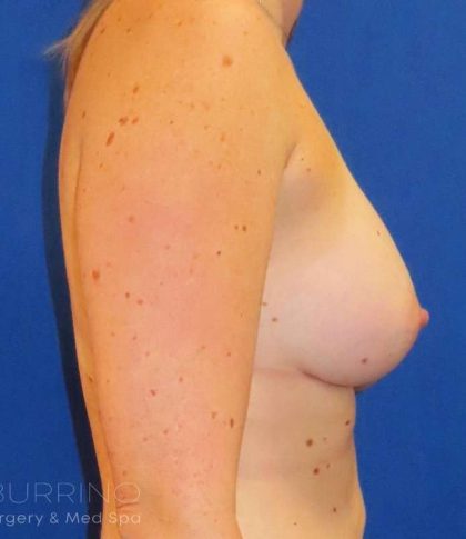 Breast Augmentation Before & After Patient #2000