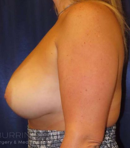 Breast Augmentation Before & After Patient #2088