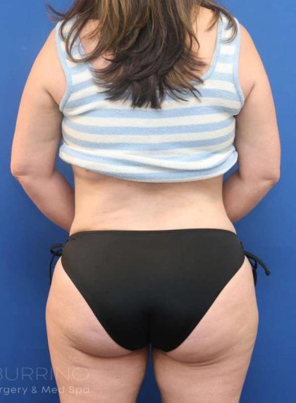 Liposuction Before & After Patient #641