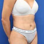Liposuction Before & After Patient #668