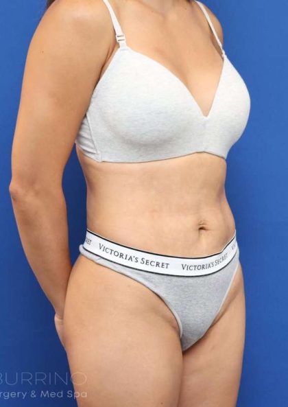 Liposuction Before & After Patient #668