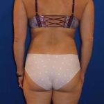 Liposuction Before & After Patient #749