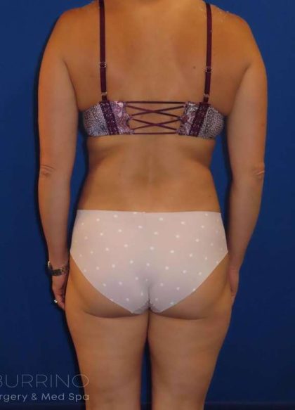Liposuction Before & After Patient #749
