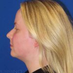 Liposuction Before & After Patient #813