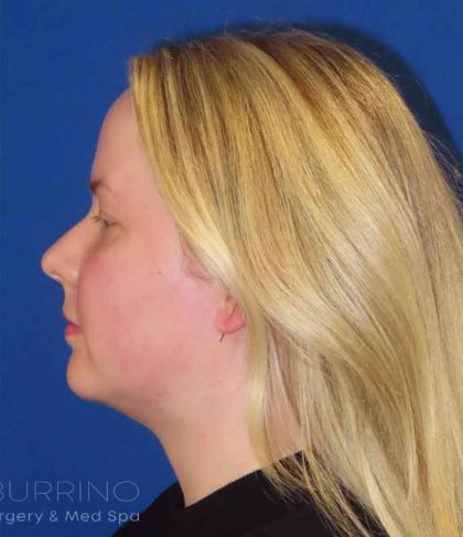 Liposuction Before & After Patient #813