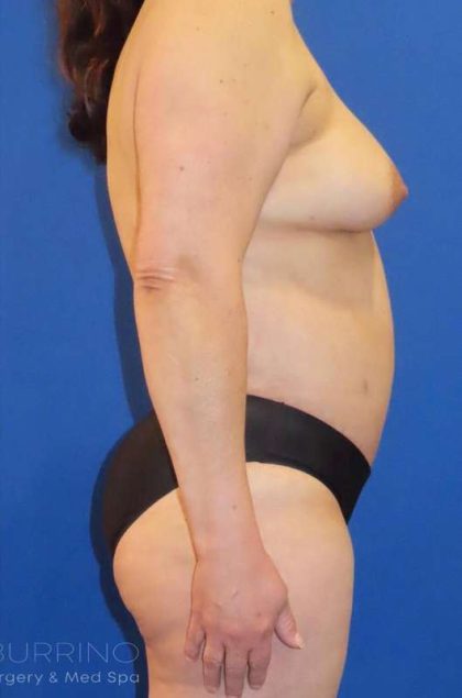 Liposuction Before & After Patient #865