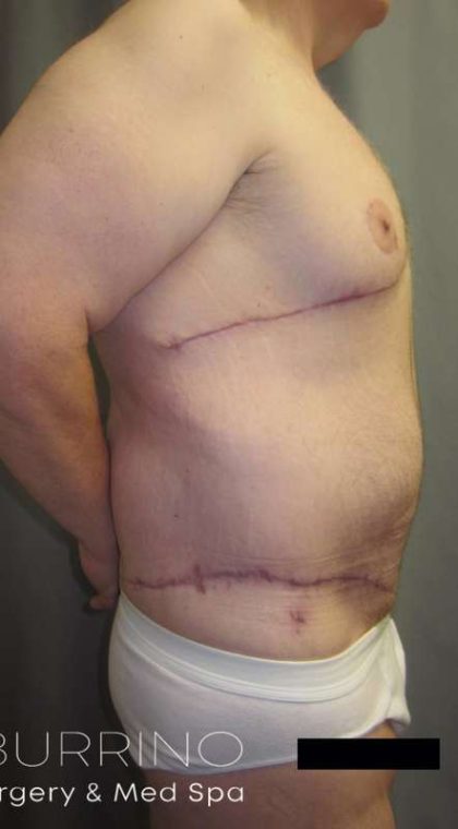 After Weight Loss Surgery Before & After Patient #1112