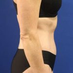 Tummy Tuck Before & After Patient #1153