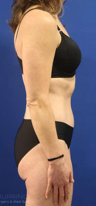Tummy Tuck Before & After Patient #1153