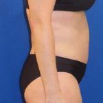 Tummy Tuck Before & After Patient #1190