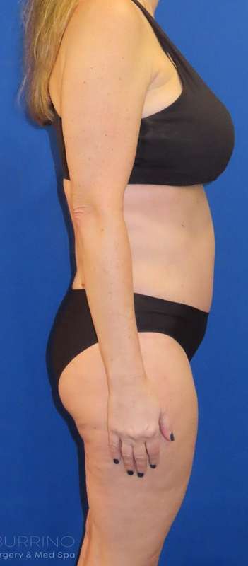 Tummy Tuck Before & After Patient #1190