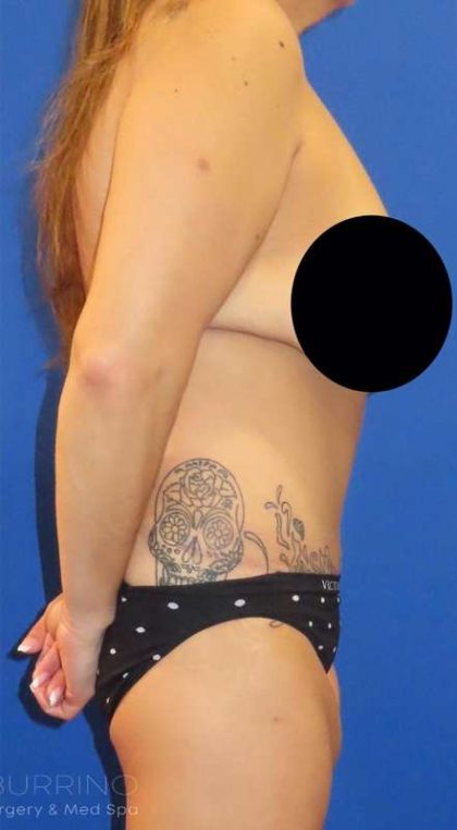Tummy Tuck Before & After Patient #1214