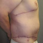 Tummy Tuck Before & After Patient #1225