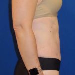 Tummy Tuck Before & After Patient #1236