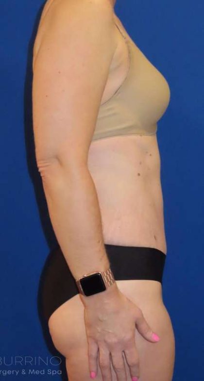 Tummy Tuck Before & After Patient #1236