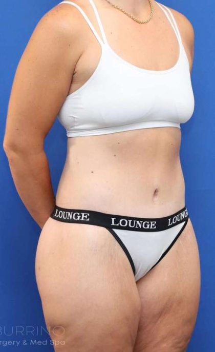 Tummy Tuck Before & After Patient #1343