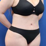 Tummy Tuck Before & After Patient #1356