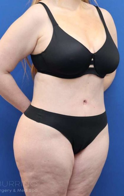 Tummy Tuck Before & After Patient #1356