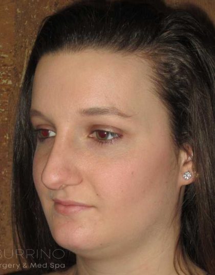 Rhinoplasty Before & After Patient #1406