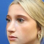 Rhinoplasty Before & After Patient #1415