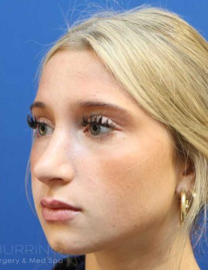 Rhinoplasty Before & After Patient #1415