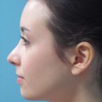 Rhinoplasty Before & After Patient #1439