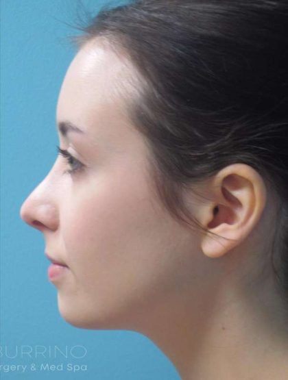Rhinoplasty Before & After Patient #1439