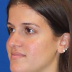 Rhinoplasty Before & After Patient #1454
