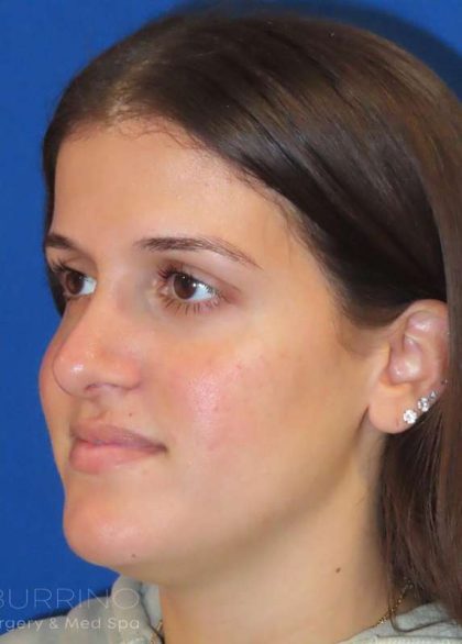 Rhinoplasty Before & After Patient #1454