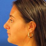 Rhinoplasty Before & After Patient #1465