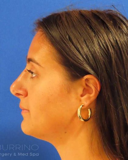 Rhinoplasty Before & After Patient #1465