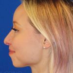 Rhinoplasty Before & After Patient #1476