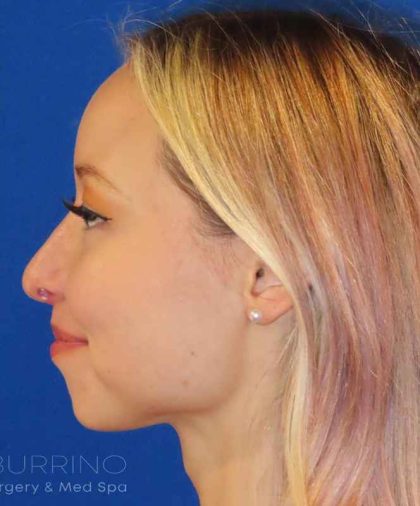 Rhinoplasty Before & After Patient #1476