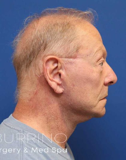 Neck Lift Before & After Patient #1487