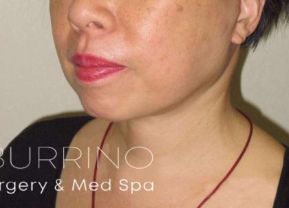 Neck Lift Before & After Patient #1498