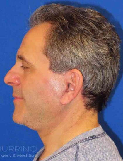 Neck Lift Before & After Patient #1560