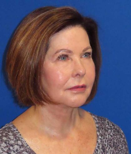 Neck Lift Before & After Patient #1578